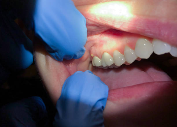 Best Emergency Dental Care for Broken or Chipped Teeth in Hawley, PA